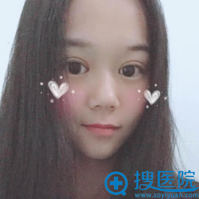 <!--<i data=20240710 data-id=13582></i>-->整形医院吴培海做的双眼皮案例 <!--<i data=20240710 data-id=13582></i>-->整形医院吴培海做的双眼皮案例