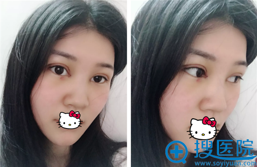 双眼皮4天术后眼睛消肿啦 双眼皮4天术后眼睛消肿啦