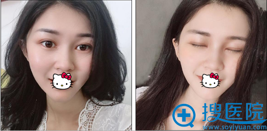 深圳丽港丽格谢俊切开双眼皮术后睁眼闭眼效果 深圳丽港丽格谢俊切开双眼皮术后睁眼闭眼效果