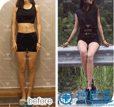 结合北京润美玉之光O型腿矫正案例和价格表选择王明利院长正腿