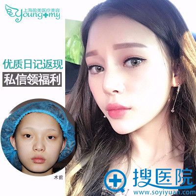 上海盈美整形医院杨璐做的双眼皮案例 上海盈美整形医院杨璐做的双眼皮案例