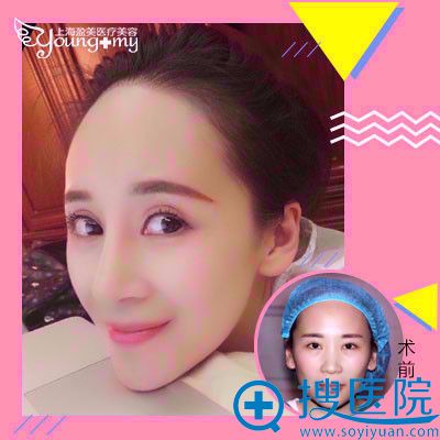 上海盈美医院整形医生杨璐做的隆鼻案例 上海盈美医院整形医生杨璐做的隆鼻案例