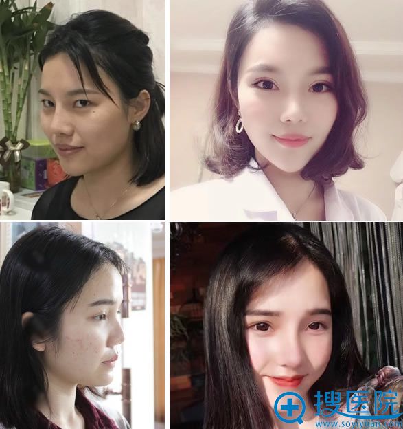 合肥壹尚美<!--<i data=20240710 data-id=16586></i>-->眼鼻综合整形案例 合肥壹尚美<!--<i data=20240710 data-id=16586></i>-->眼鼻综合整形案例