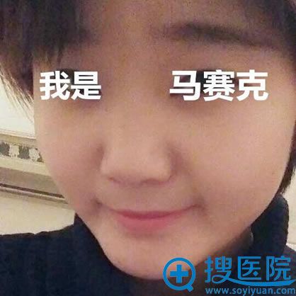硅胶隆鼻多少钱?找淮北微悦周创业医生做花了我3800元起