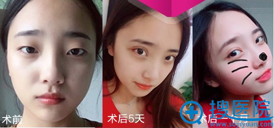 淮北东方美莱坞吴磊做的全切双眼皮案例 淮北东方美莱坞吴磊做的全切双眼皮案例