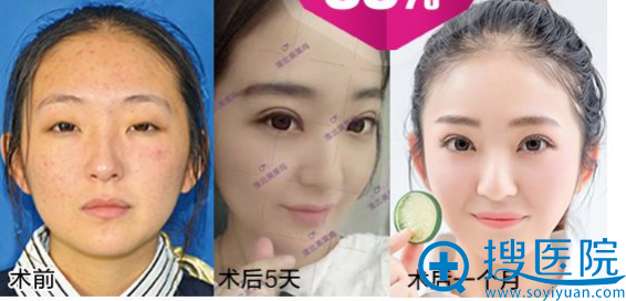 淮北东方美莱坞医疗美容整形医院吴磊做的双眼皮案例 淮北东方美莱坞医疗美容整形医院吴磊做的双眼皮案例
