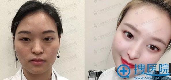 广州华美自体脂肪填充全脸效果案例 广州华美自体脂肪填充全脸效果案例