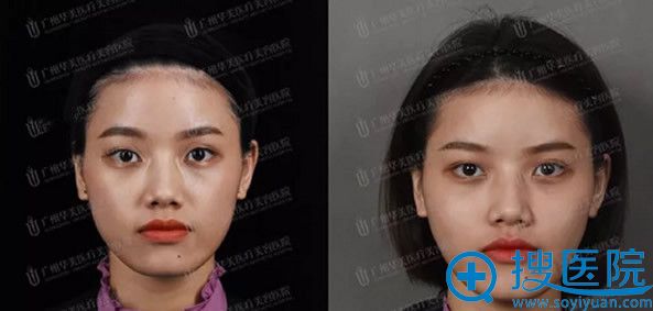 华美面部注射玻尿酸效果好不好 华美面部注射玻尿酸效果好不好