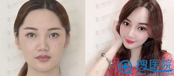 广州华美自体脂肪填充面部一年后的效果对比图 广州华美自体脂肪填充面部一年后的效果对比图