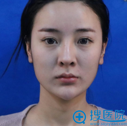 看了上海华美谢卫国的隆鼻案例后花5万元找李庭勋做了隆鼻修复