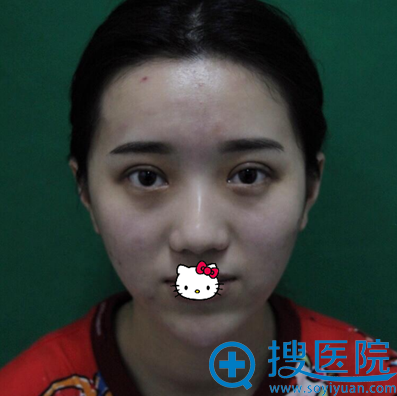 刚在南宁韩成整形医院做了双眼皮又找刘泳铖做了鼻综合手术