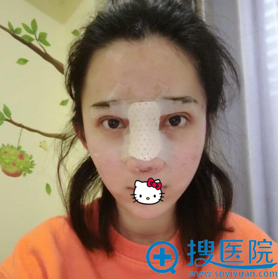 刘泳铖鼻综合术后即刻效果 刘泳铖鼻综合术后即刻效果