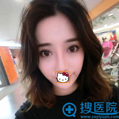 刘泳铖鼻综合术后3个月恢复照片 刘泳铖鼻综合术后3个月恢复照片