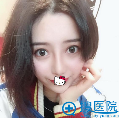 南宁韩成双眼皮+鼻综合手术效果展示 南宁韩成双眼皮+鼻综合手术效果展示