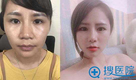 佛山华美雷朝勇耳软骨复合隆鼻案例 佛山华美雷朝勇耳软骨复合隆鼻案例
