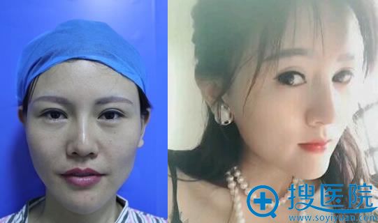 佛山华美<!--<i data=20240710 data-id=16531></i>-->鼻修复案例 佛山华美<!--<i data=20240710 data-id=16531></i>-->鼻修复案例