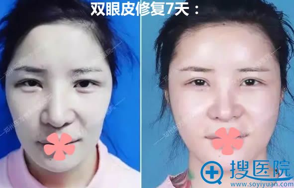 双眼皮二次修复案例图及7天后前后对比效果 双眼皮二次修复案例图及7天后前后对比效果