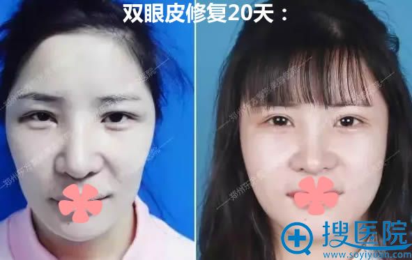 让郑州东方的朴大焕做完双眼皮修复术后20天对比照 让郑州东方的朴大焕做完双眼皮修复术后20天对比照