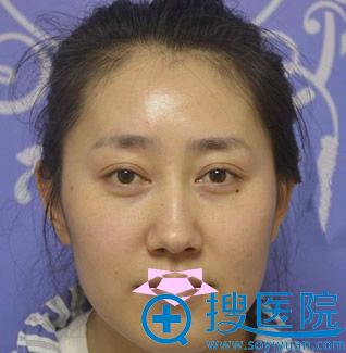 让太原美诗沁李旭东做了自体脂肪面部填充 同事说我“18岁”