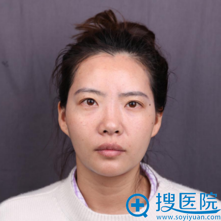 肋软骨隆鼻多少钱?上海华美李健做膨体加肋软骨隆鼻费用5万元