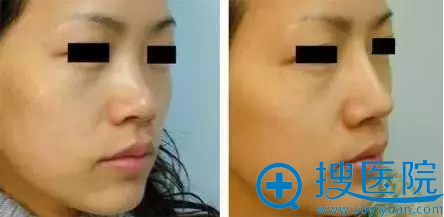 哪种玻尿酸适合隆鼻?玻尿酸隆鼻的价格是多少?