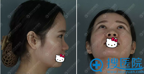 鼻综合手术前面诊设计手术方案 鼻综合手术前面诊设计手术方案