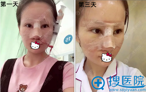 东莞美立方隆鼻术后即刻照片 东莞美立方隆鼻术后即刻照片