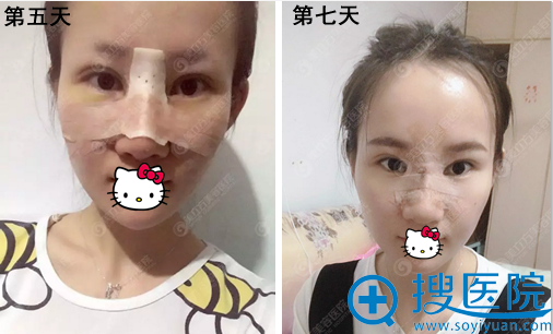 鼻综合消肿后照片 鼻综合消肿后照片