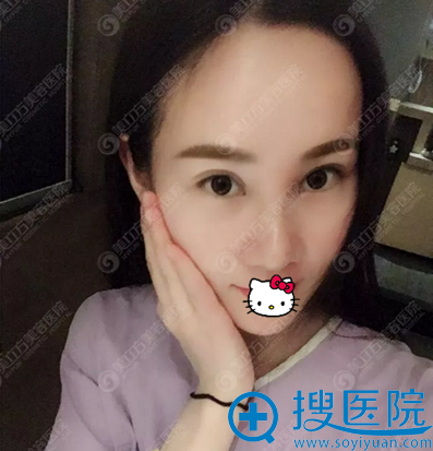 东莞美立方假体隆鼻术后效果 东莞美立方假体隆鼻术后效果