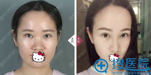 东莞美立方鼻综合术后对比照 东莞美立方鼻综合术后对比照
