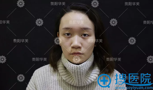 对比了贵阳华美和美莱的案例价格后找做了双眼皮和隆鼻
