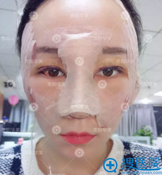 做完双眼皮隆鼻子和脂肪填充术后天 做完双眼皮隆鼻子和脂肪填充术后天