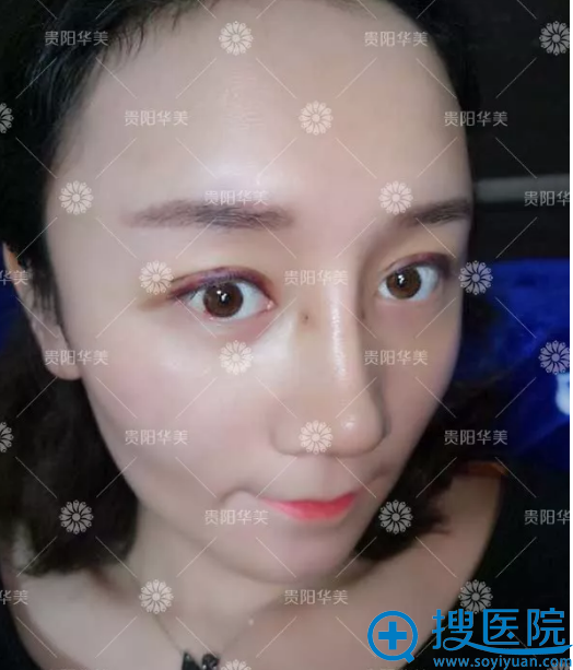 贵阳华美<!--<i data=20240710 data-id=16786></i>-->院长做的双眼皮隆鼻案例图 贵阳华美<!--<i data=20240710 data-id=16786></i>-->院长做的双眼皮隆鼻案例图