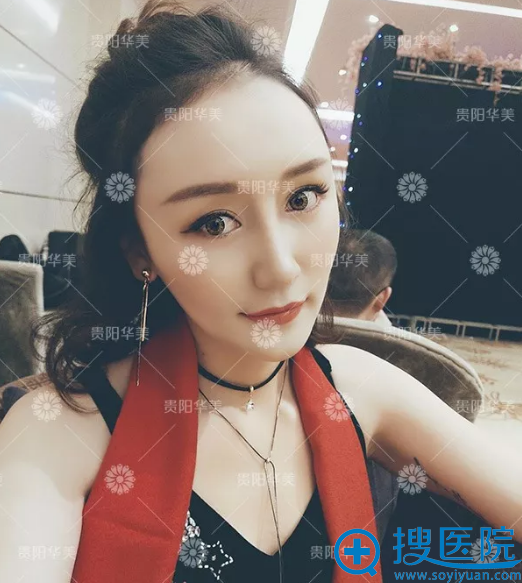在贵阳华美做的双眼皮隆鼻术后一个月图片 在贵阳华美做的双眼皮隆鼻术后一个月图片