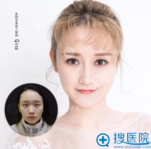 贵阳华美<!--<i data=20240710 data-id=16786></i>-->做的双眼皮隆鼻子案例对比图 贵阳华美<!--<i data=20240710 data-id=16786></i>-->做的双眼皮隆鼻子案例对比图