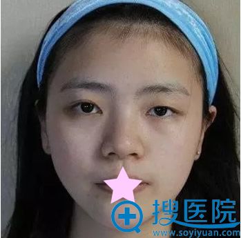 <!--<i data=20240710 data-id=9770></i>-->整形割双眼皮前 <!--<i data=20240710 data-id=9770></i>-->整形割双眼皮前