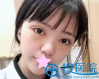 双眼皮第十天拆线后 双眼皮第十天拆线后