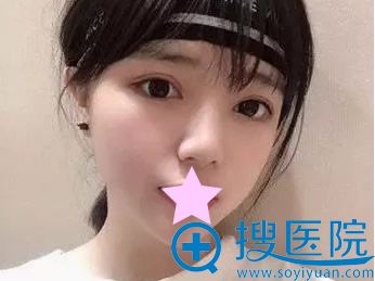 <!--<i data=20240710 data-id=9770></i>-->割双眼皮15天效果 <!--<i data=20240710 data-id=9770></i>-->割双眼皮15天效果