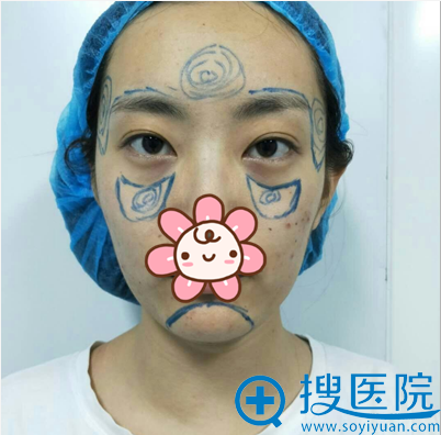 郑州元素美学整形鲁亚东做全脸脂肪填充怎么样?分享下我的经验