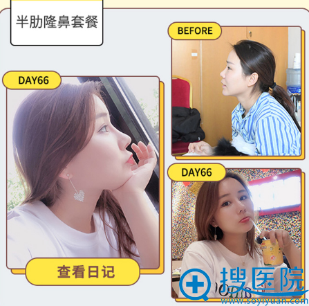 苏州紫馨赵延峰做的鼻综合隆鼻案例 苏州紫馨赵延峰做的鼻综合隆鼻案例