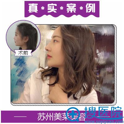 <!--<i data=20240710 data-id=13583></i>-->尹飞做的鼻综合隆鼻案例 <!--<i data=20240710 data-id=13583></i>-->尹飞做的鼻综合隆鼻案例
