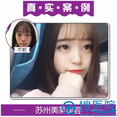 <!--<i data=20240710 data-id=13583></i>-->张亮做的双眼皮案例 <!--<i data=20240710 data-id=13583></i>-->张亮做的双眼皮案例
