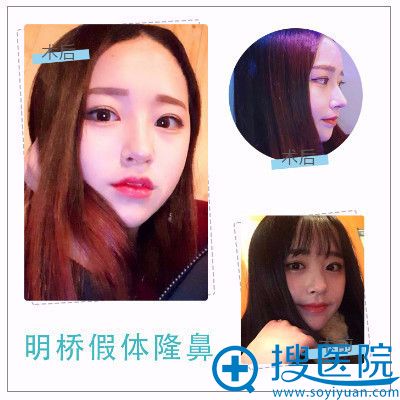 <!--<i data=20240710 data-id=12576></i>-->整形医院孙超做的隆鼻案例 <!--<i data=20240710 data-id=12576></i>-->整形医院孙超做的隆鼻案例