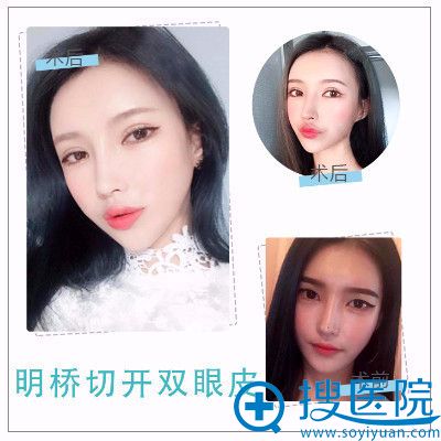 <!--<i data=20240710 data-id=12576></i>-->整形医院王建武院长做的双眼皮案例 <!--<i data=20240710 data-id=12576></i>-->整形医院王建武院长做的双眼皮案例