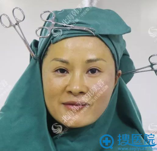 面部做完一侧线雕提升效果对比 面部做完一侧线雕提升效果对比