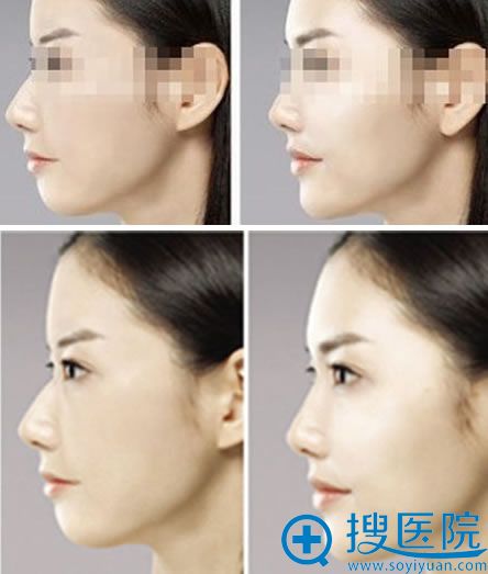 玻尿酸丰下巴真人案例效果图 玻尿酸丰下巴真人案例效果图