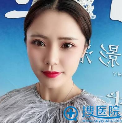 福州海峡整形医院林秀兰医生做的双眼皮案例 福州海峡整形医院林秀兰医生做的双眼皮案例