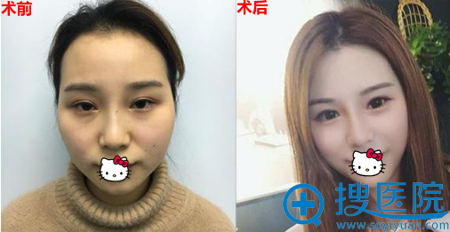 看成都美熹刘家亘院长用假体丰太阳穴+丰下巴帮我重塑面部轮廓