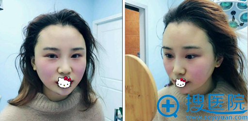 成都美熹膨体丰太阳穴+下巴术后即刻效果 成都美熹膨体丰太阳穴+下巴术后即刻效果