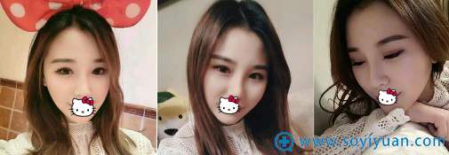 假体丰太阳穴和下巴术后2个月美照 假体丰太阳穴和下巴术后2个月美照
